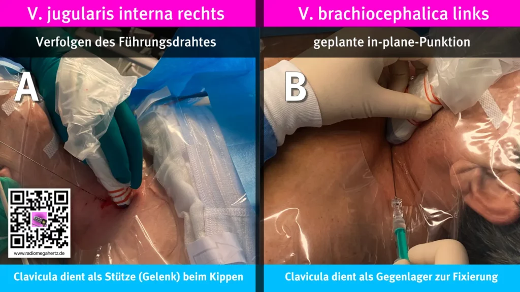 Sondenmanöver wir das Kippen kann durch ein Wiederlager, in diesem Fall die Clavicula, erleichtert werden: Der Führungsdraht kann von der V. jugularis interna bis zur V. brachiocephalica verfolgt werden | Radiomegahertz.