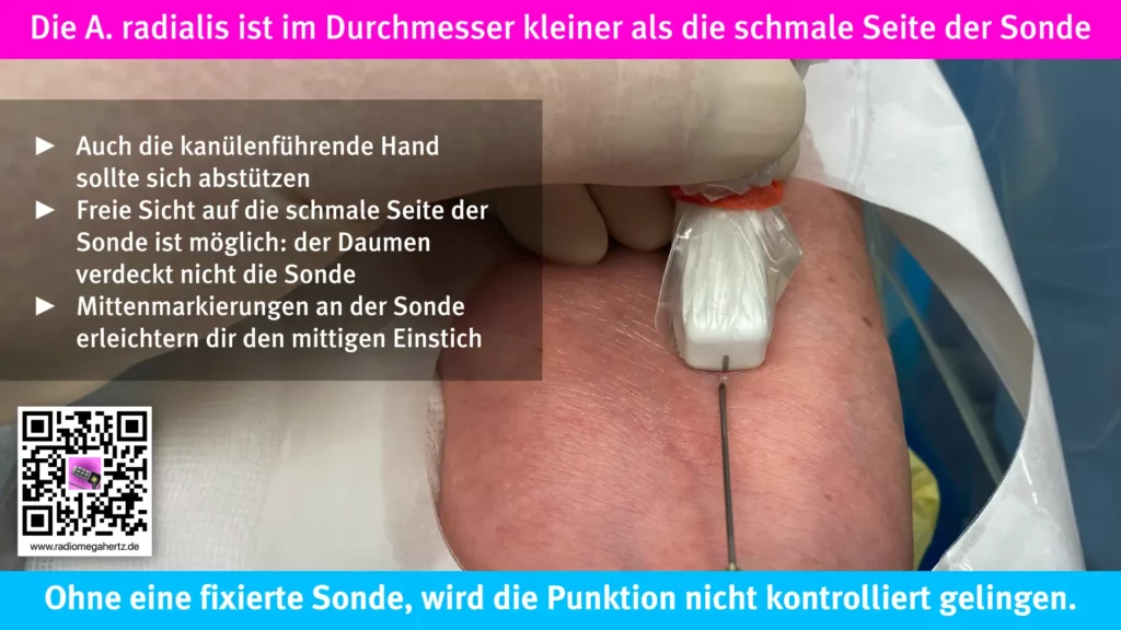 Bei kleinen Punktionszielen wie die A. radialis ist es unabdingbar, Sonde und Kanüle exakt mit minimalen Bewegungen kontrollieren zu können. Stütze dafür mit den Händen ab. Beispiel: A. radialis Punktion in der in-plane Technik. Radiomegahertz.