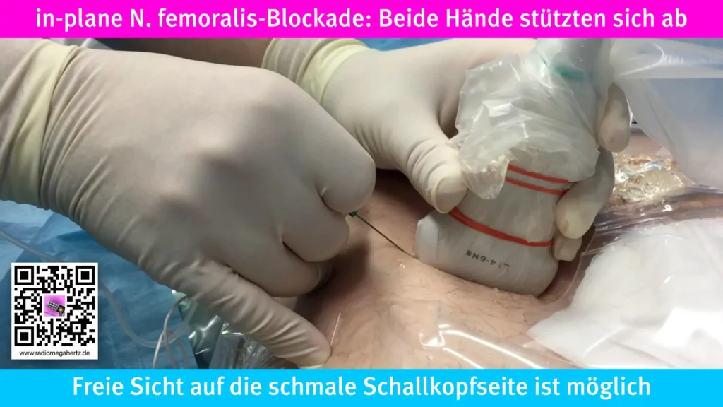 N. femoralis-Blockade in in-plane Technik. Die schallkopführende Hand und die kanülenführende Hand stützten sich ab. Radiomegahertz