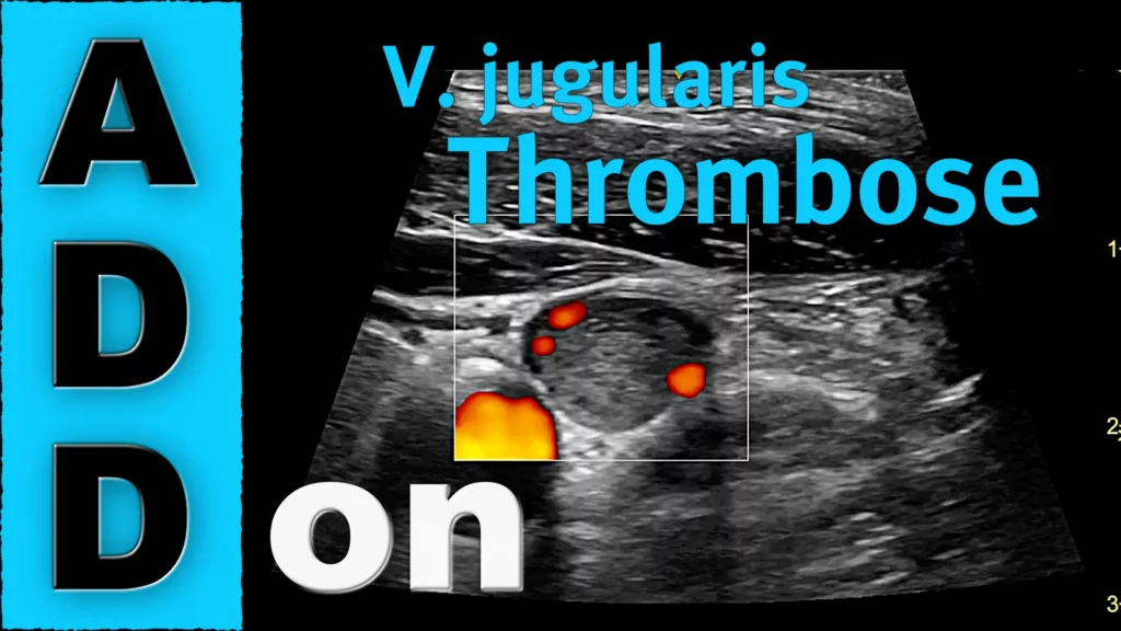 V. jugularis Thrombose als Nebenbefund während einer ZVK Anlage. Blogbeitrag Radiomegahertz