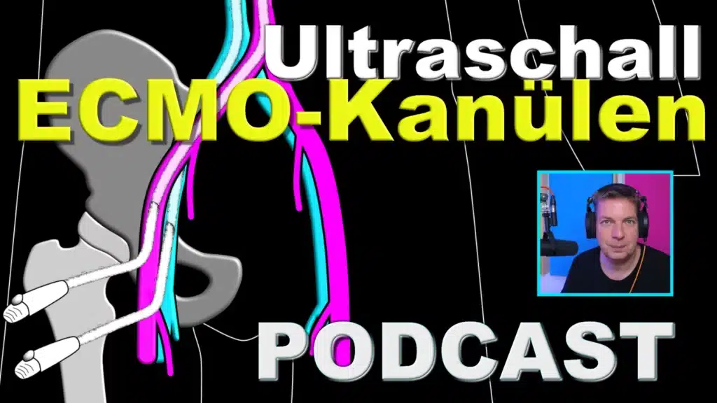 Ultraschall für die Anlage von ECMO Kanülen. Darum solltest du Ultraschall verwenden. Radiomegahertz