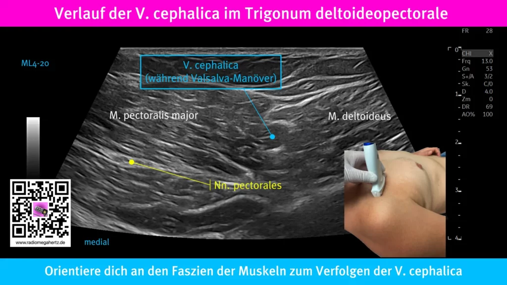 Die Vena cephalica kann zwischen den Mm. deltoideus und pectoralis major zwischen den Fazien im Trigonum deltoideopectorale dargestellt werden. Ein Valsalva-Manöver erhöht die Venenfüllung. Radiomegahertz