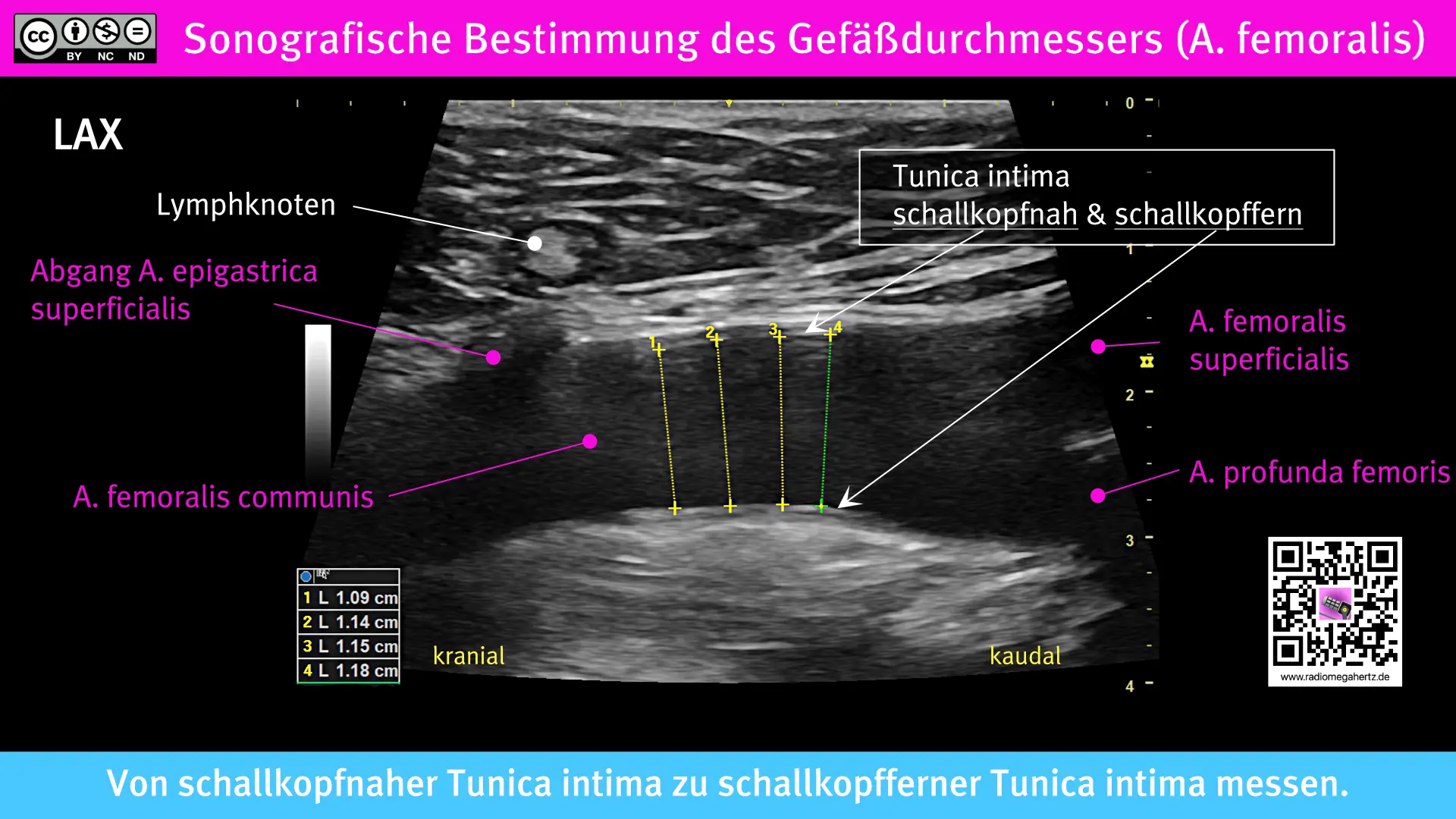 Der Arteriendurchmesser kann vor der ECMO Kanülierung sonografisch einfach bestimmt werden. Radiomegahertz